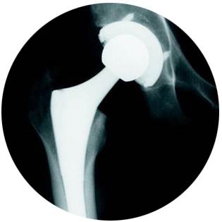 Hip replacement - X-ray