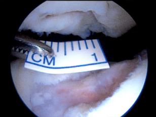 An arthroscopic view inside a young patient's knee joint with the patella and trochlea
