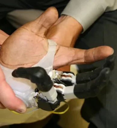 Reconstructive Center for Lost Limbs | Orthopedic Care