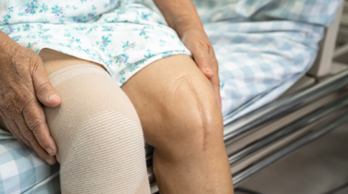 Knee Arthritis Relief: Expert Insights Knee Replacement Recovery