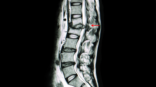 Scan of a spine | Degenerative Disc Disease