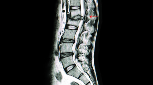 Scan of a spine | Degenerative Disc Disease