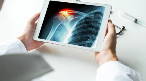 Shoulder Impingement scan on an a tablet