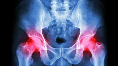 hip x-ray from orthocarolina