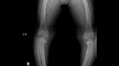 Blount's Disease, X-ray