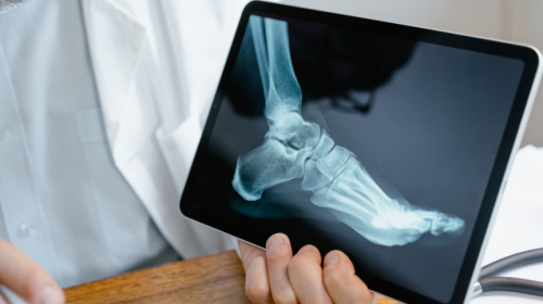 What You Need to Know About Bone Density and Osteoporosis