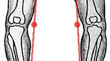 bowed-legs