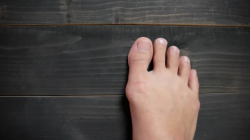 bunion on right foot
