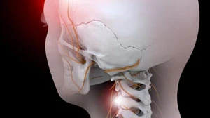 Cervicogenic Headaches
