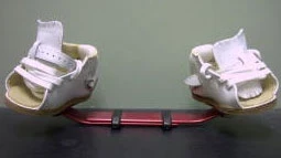 clubfoot