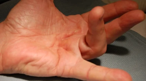 Dupuytren's contracture OrthoCarolina