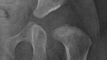 Hip X-ray