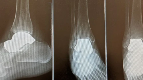 Talus Foot and Ankle X-ray Image