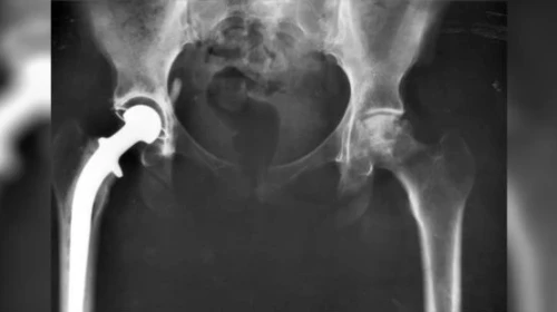 Hip X-ray from OrthoCarolina