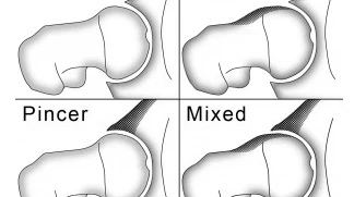 femoroacetabular impingement