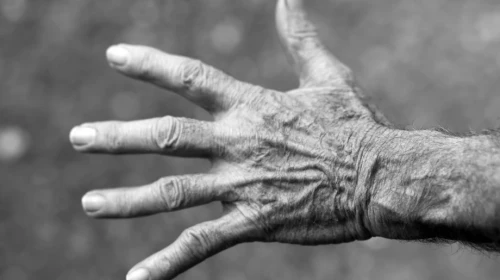 Basilar Joint (thumb) Arthritis