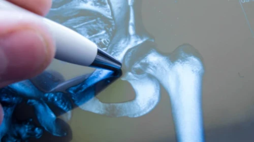 Periprosthetic joint infection.