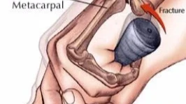 Fracture of the hook of hamate