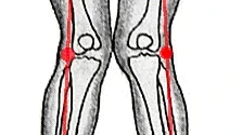 knock-knees diagrams