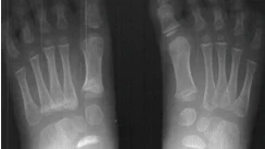 X-ray of Feet