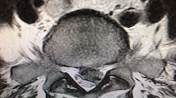 The Scoop on Sciatica