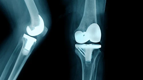 The Pros & Cons of Bilateral Knee Replacement