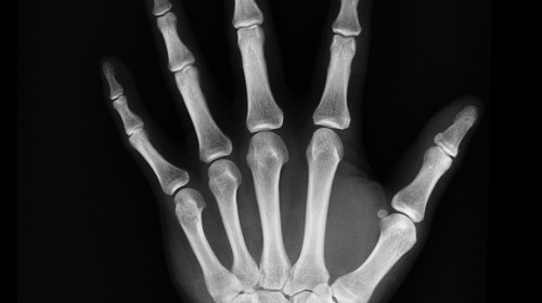 X-ray