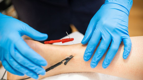 Dry Needling