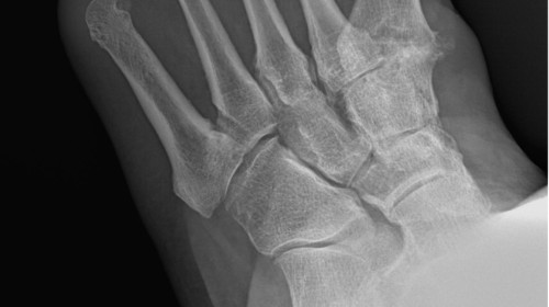 Arthritis