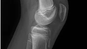 Knee X-ray
