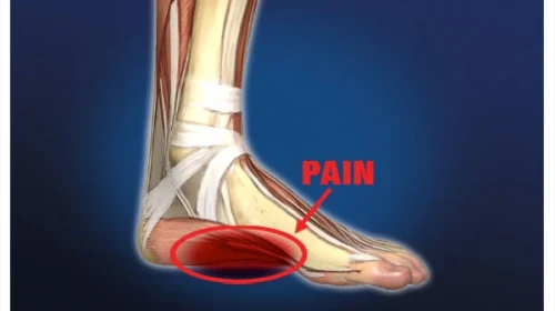 Plantar Fasciitis