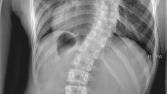 X-ray of scoliosis patient