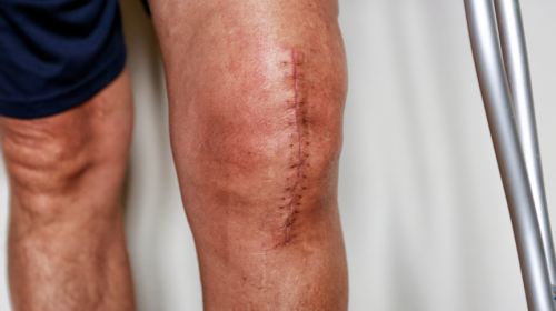patient with recent knee replacement surgery