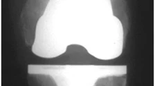 Joint Replacement