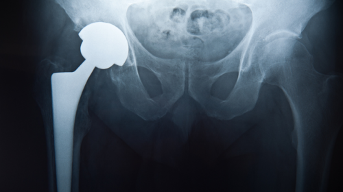 X ray of hip joint replacement