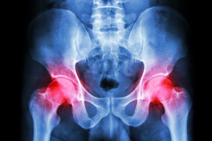 hip x-ray from orthocarolina