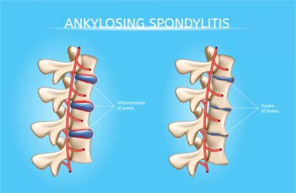Rock Musicians Bring New Awareness to Ankylosing Spondylitis