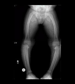 Blount's Disease, X-ray