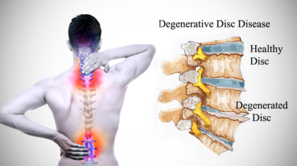 Scan of a spine | Degenerative Disc Disease