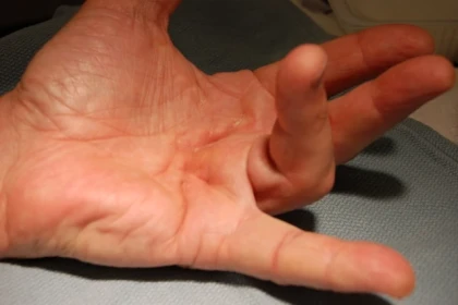 Dupuytren's contracture OrthoCarolina