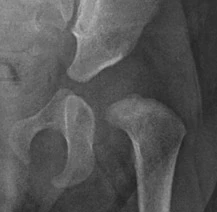 Hip X-ray