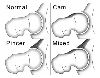 femoroacetabular impingement