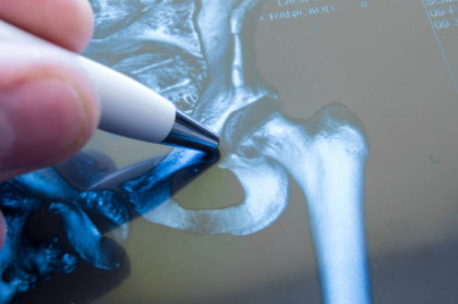 Periprosthetic joint infection.