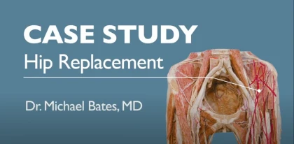Hip Replacement Surgery - Case Study