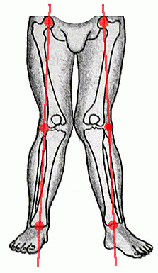 knock-knees diagrams