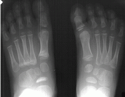 X-ray of Feet
