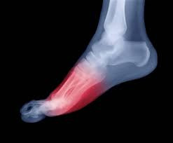 Common Foot Conditions Treated with Orthotics