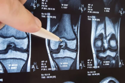 Cartilage 101 | Healthy Cartilage | OrthoCarolina Orthopedic Library