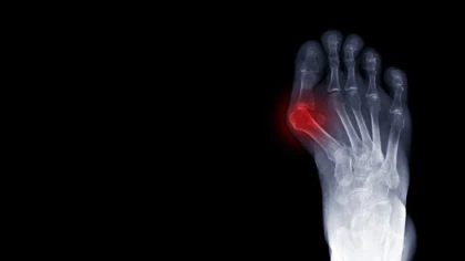 Bunions Xray