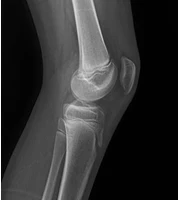 Knee X-ray